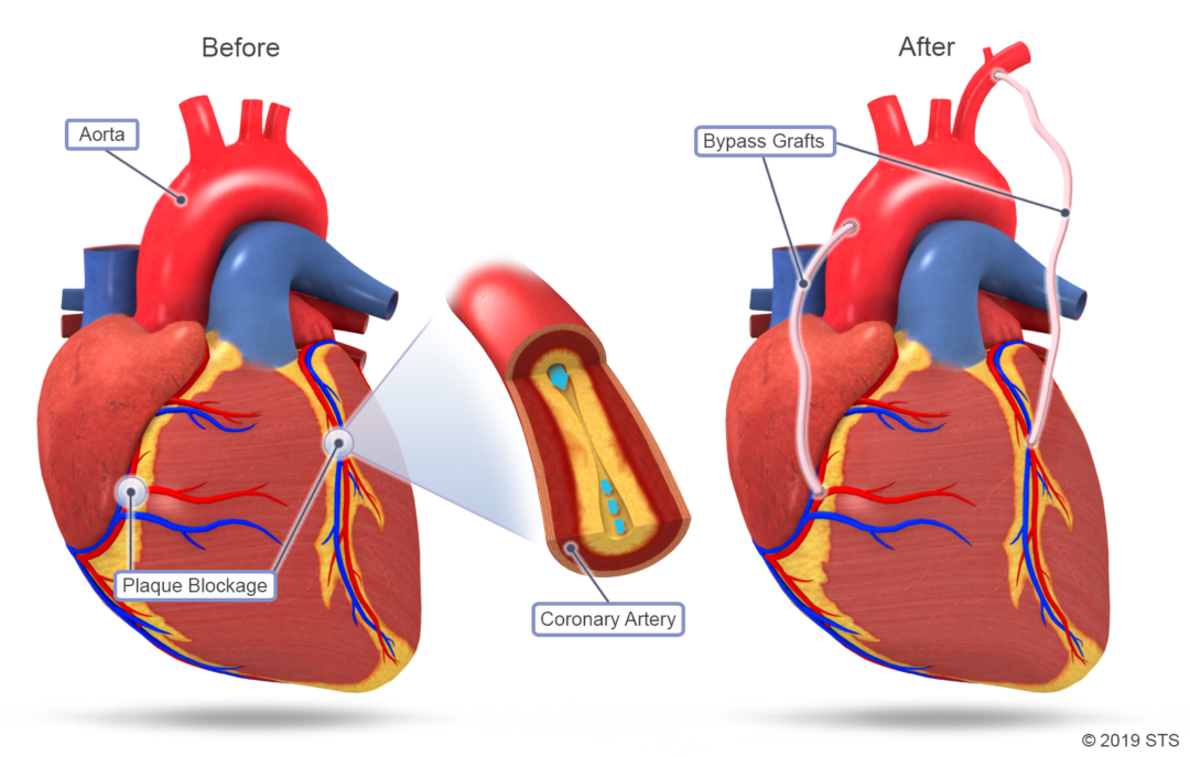 a-brief-idea-about-cabg-heart-surgery-is-given-by-pritish-halder