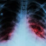 Interpreting the Disease and Treatment of Tuberculosis